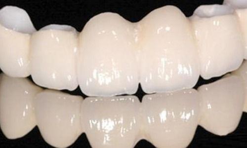 国产全瓷牙冠多少钱一颗,一颗牙冠的美丽投资